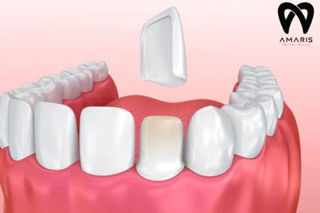 طول عمر کامپوزیت دندان چقدر است؟