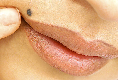 عکس سرطان پوست,خال بالای لبها PRinc_photo_of_benign_nevus_above_lip