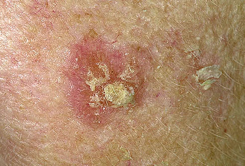 عکس سرطان پوست,کراتوز اکتینیک actinic_keratosis