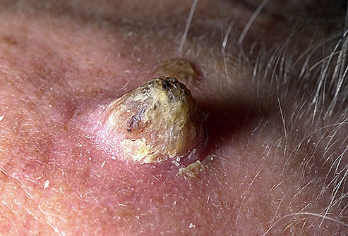 عکس سرطان پوست,dermnet_photo_of_cutaneous_horn شاخ پوستی