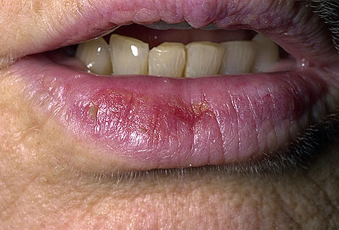 عکس سرطان پوست,dermnet_photo_of_actinic_cheilitis التهاب لب اکتینیک