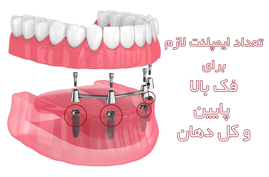 تعداد ایمپلنت لازم برای فک بالا، پایین و کل دهان