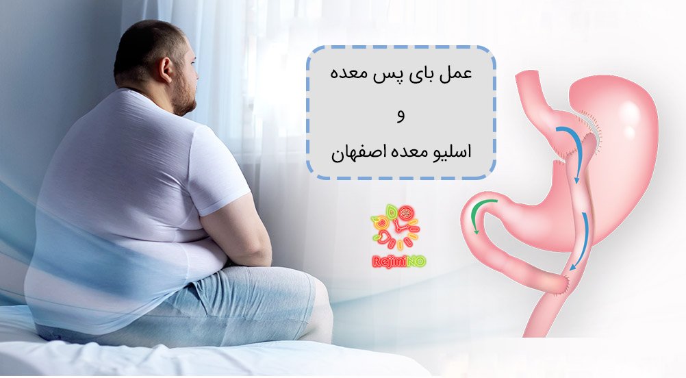 عمل اسلیو و بای پس معده
