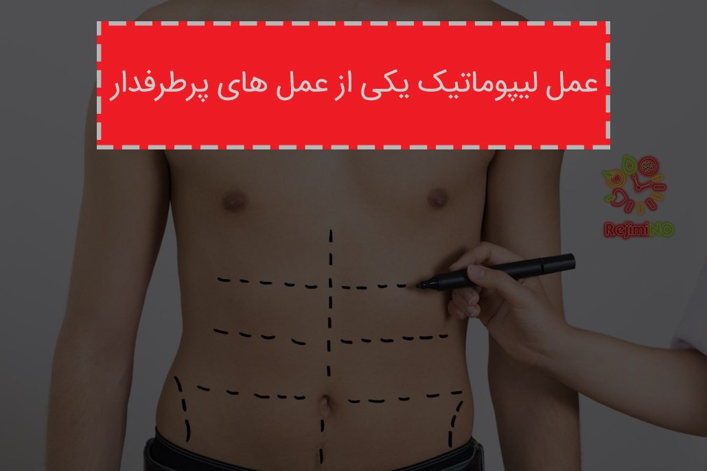 عمل لیپوماتیک