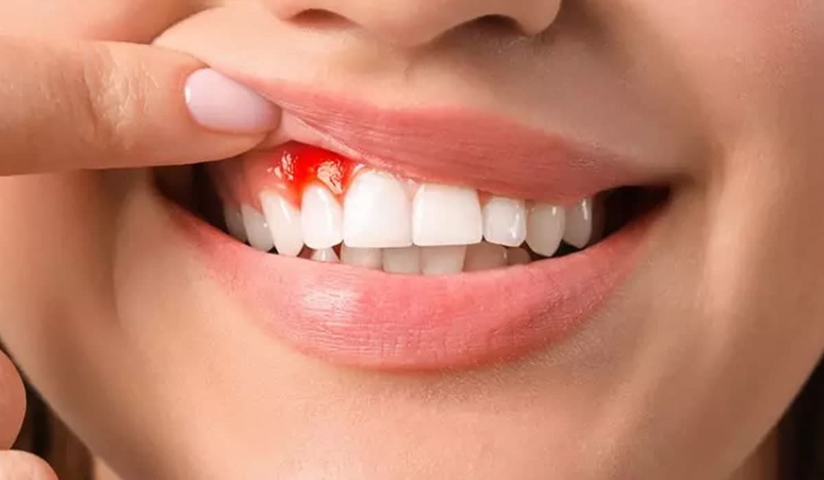 راه های جلوگیری از خونریزی دندان