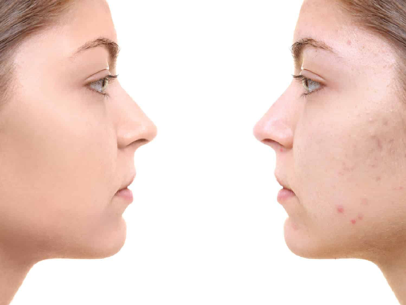 راهنمای خرید سرم ضد جوش مجله سلامت