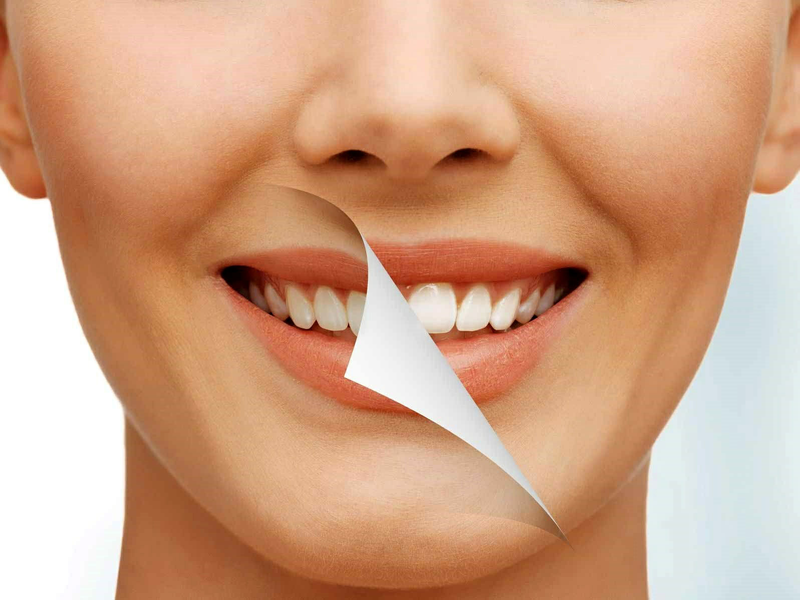 آیا لمینت دندان دائمی است؟ مجله سلامت