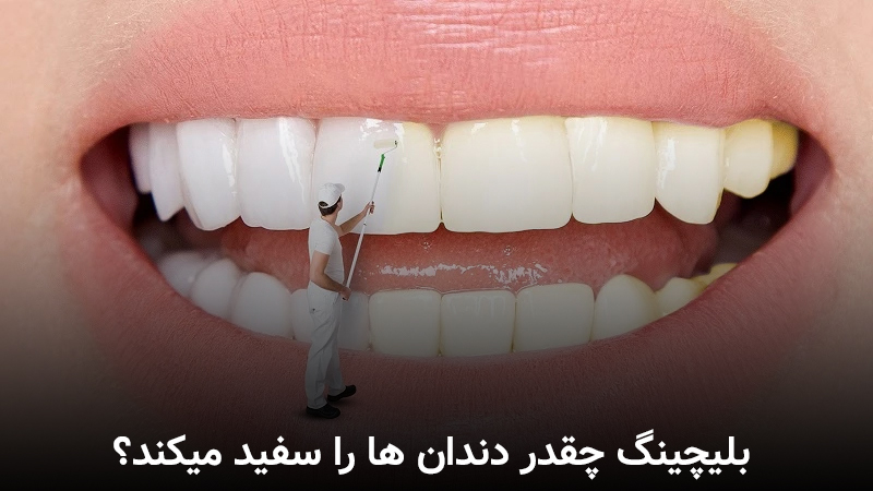 بلیچینگ چقدر دندان ها را سفید میکند؟ مجله سلامت