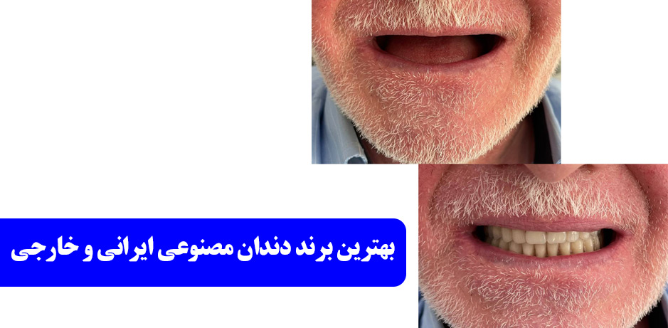 بهترین برند دندان مصنوعی ایرانی و خارجی مجله سلامت