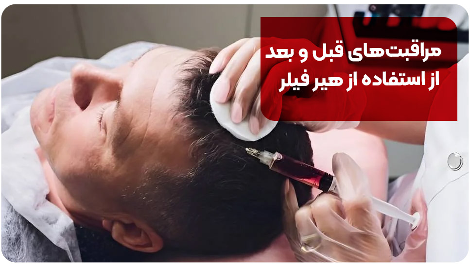 مراقبت های قبل و بعد از استفاده از هیر فیلر