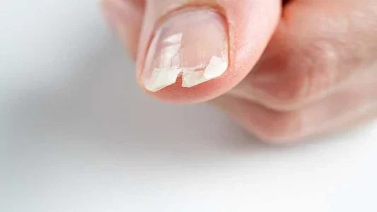 برای درمان نازک شدن ناخن بعد از ژلیش چه باید کرد؟